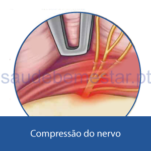 Compressão do nervo