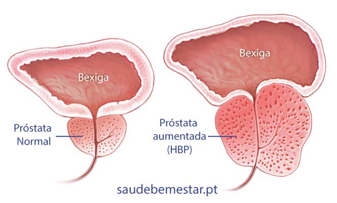 hiperplasia prostata maligna