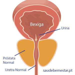 Hiperplazia benignă de prostată - cauze, simptome, tratament