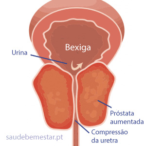 prostata aumentata di volume)