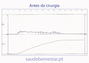 Antes da cirurgia RTU-P