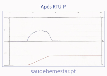 Antes da cirurgia RTU-P