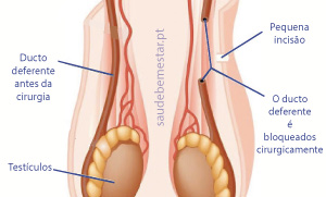 Cirurgia de vasectomia