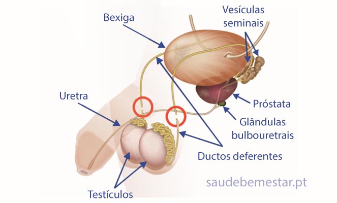 Fotos, imagens de vasectomia