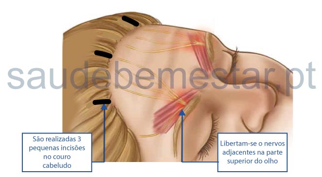 Cirurgia na enxaqueca