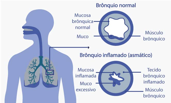 Imagens de asma alérgica