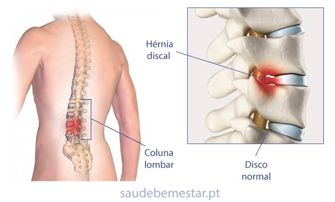 Fisioterapia e reabilitação na Hérnia Discal (de disco) Lombar