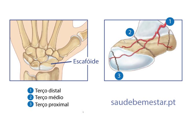 Fratura (osso partido) do escafóide