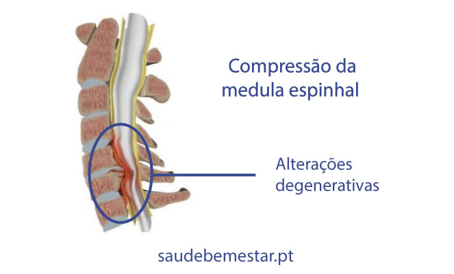 Mielopatia cervical