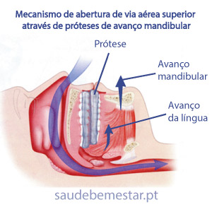 Avanço mandibular na roncopatia