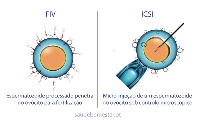 Fertilização in Vitro