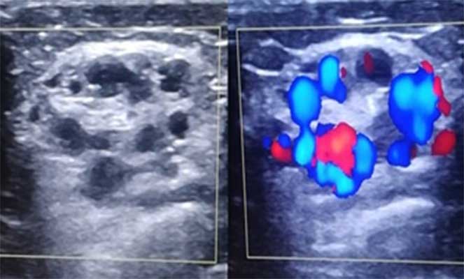 Malformação vascular