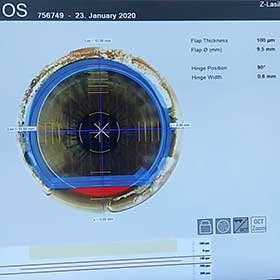 Operação com LASIK no astigmatismo