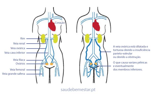 Varicoză de pelvis mic în timpul sarcinii