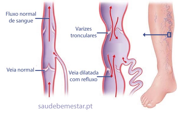 Cirurgia de varizes