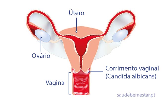 Candidíase vaginal - o que é, causas, sintomas, tratamento, cura