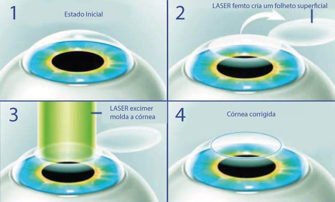 Cirurgia Lasik