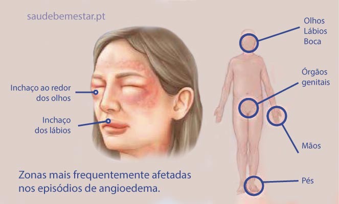 Imagens de angioedema