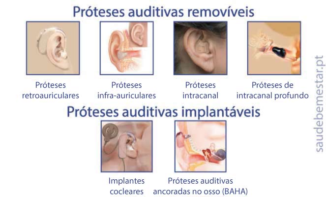 Estrutura básica do aparelho auditivo retroauricular analógica