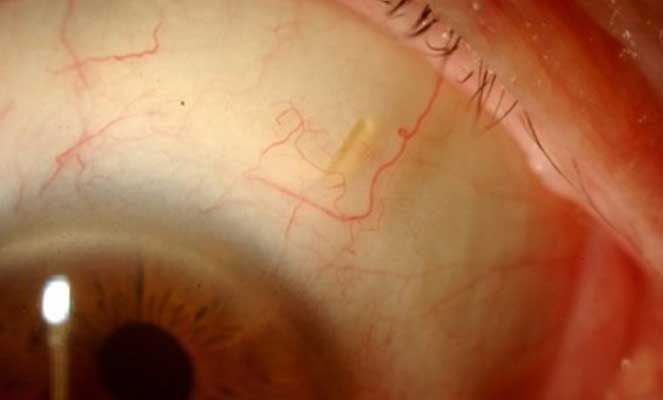 Cirurgia no glaucoma