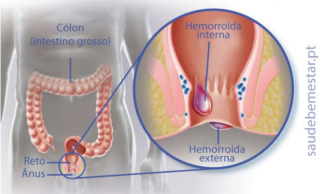 Que hacer cuando sangran las hemorroides