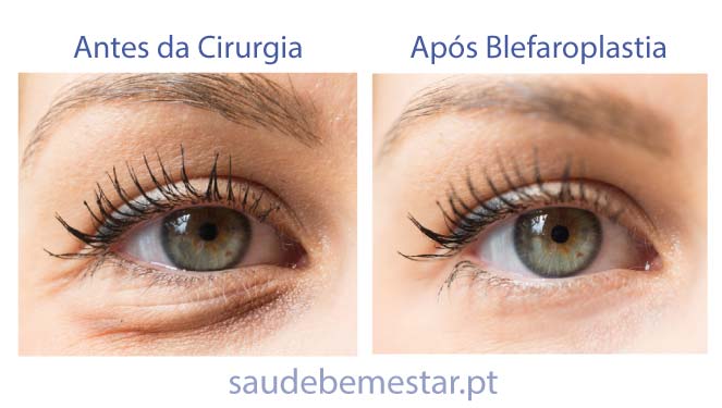 Cirurgia de blefaroplastia