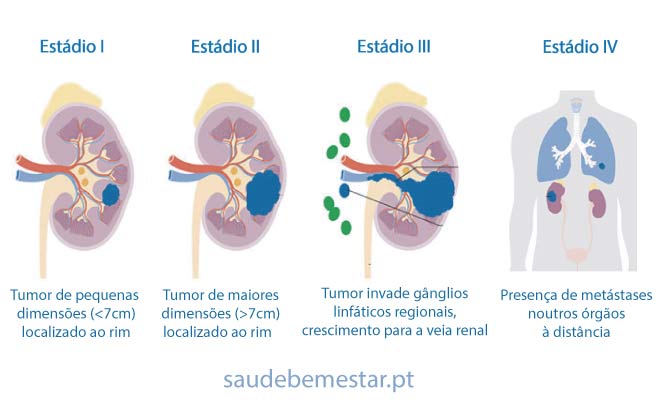 Cancro do rim