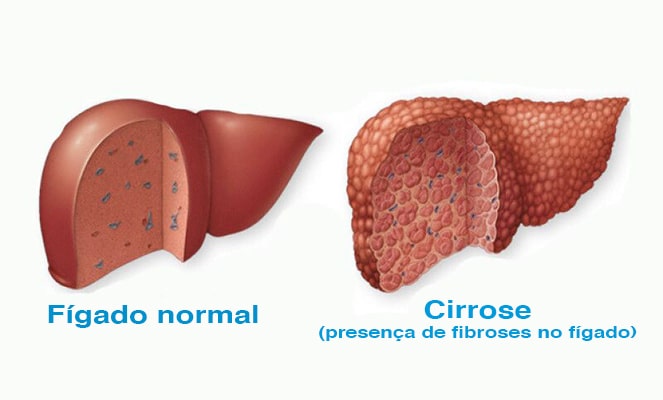 imagens de  Cirrose