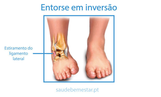 Entorse do Tornozelo