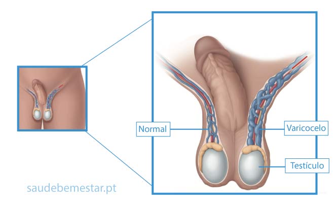 Varicocelo