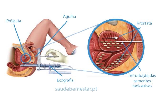 cancer prostata tratamento)