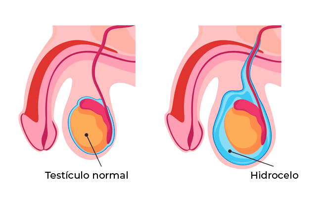 Hidrocelo