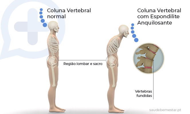 Espondilite anquilosante