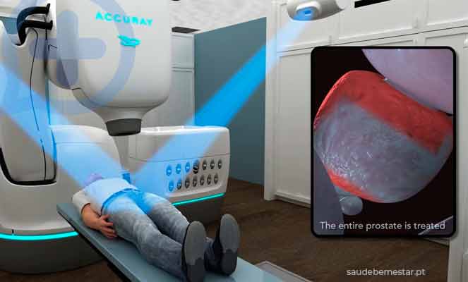 Radioterapia estereotáxica robótica