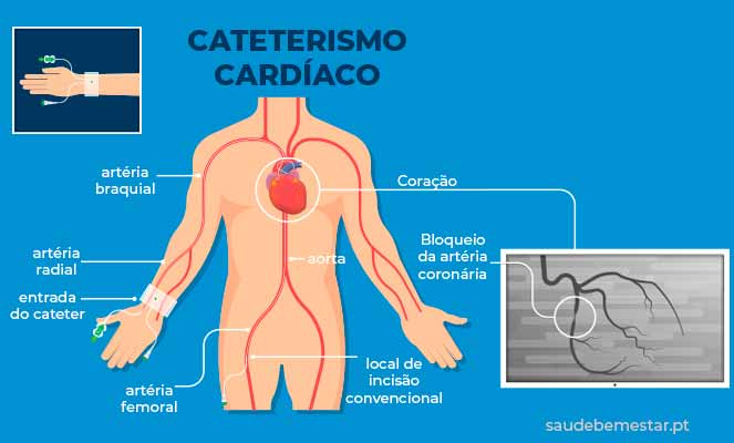 Cateterismo cardíaco