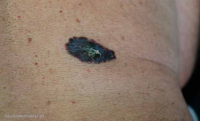 Imagens de melanoma