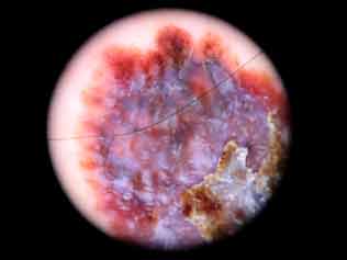 Diagnóstico de Melanoma