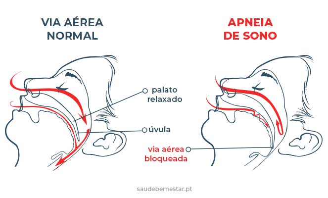 Clinica Jin - Apneia e seu risco na saúde. Saiba como se prevenir