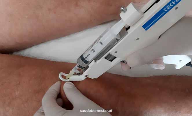 Mesoterapia