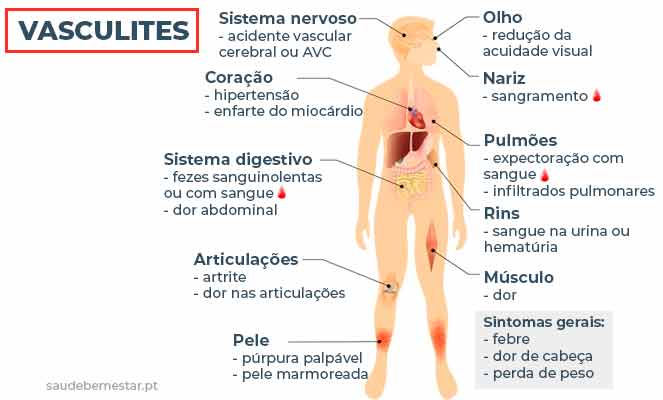 Coágulo de sangue: causas, tipos e tratamentos - Minha Vida