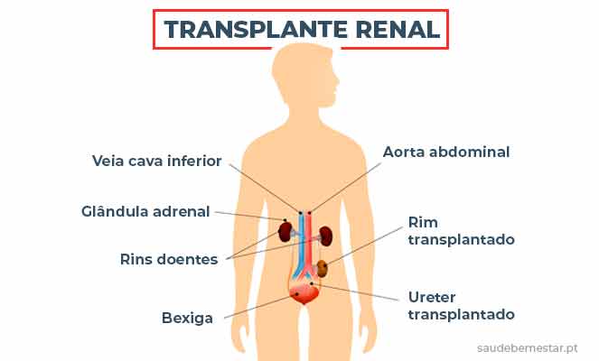 Transplante Renal