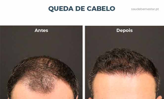 Imagens de queda de cabelo