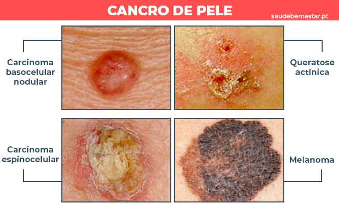 Imagens de cancro da pele