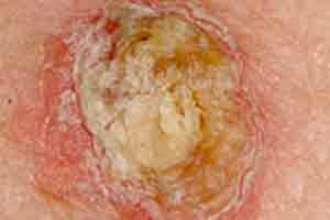 Carcinoma Espinocelular