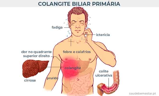 Colangite biliar primária
