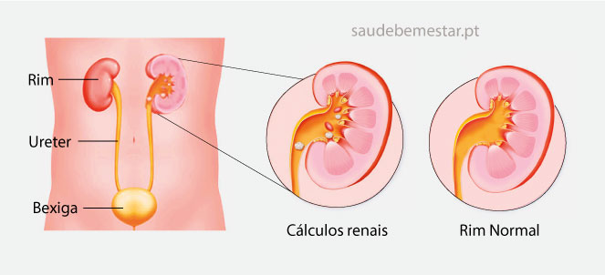 Fotos, imagens de pedra nos rins