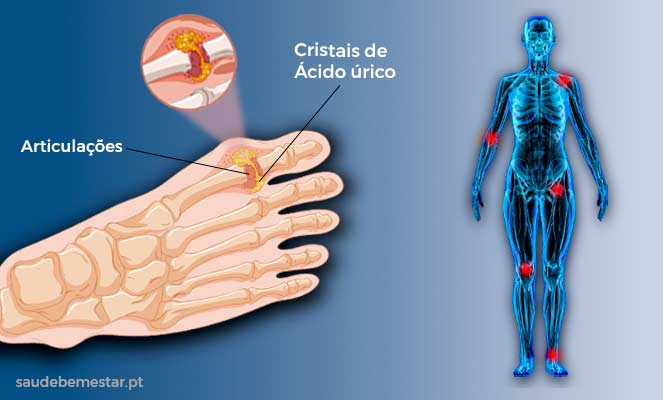 Alimentos prohibidos para ácido úrico elevado síntomas gota