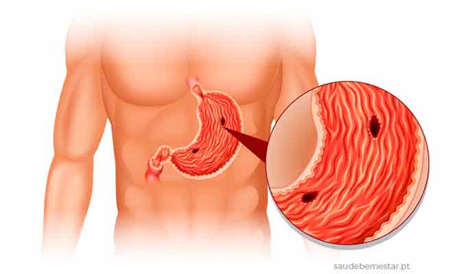 imagens de Úlcera no estômago