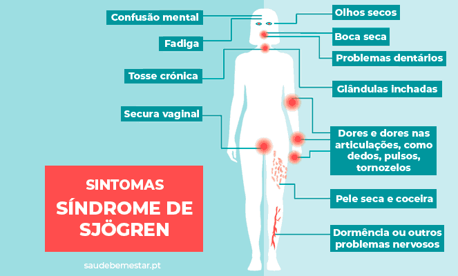 Síndrome de Sjögren