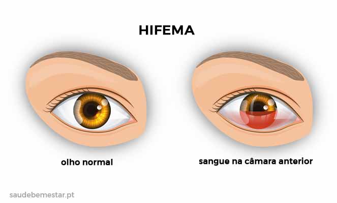 Hifema